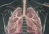 Malattie respiratorie, Blasi “Prevenzione e sport fondamentali per la salute dei polmoni”